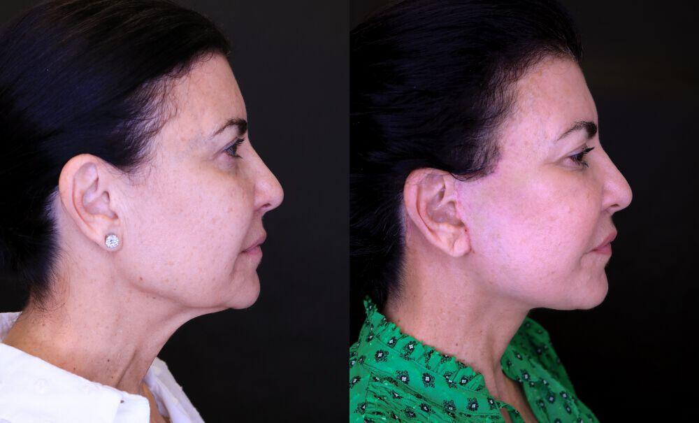 Neck Lift before and after - before