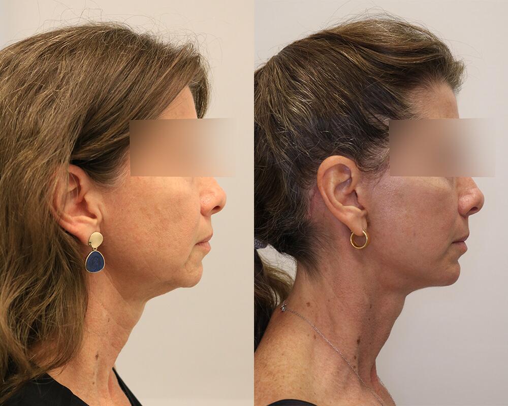 Facelift before and after - before