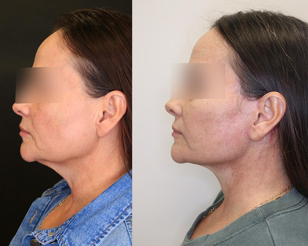 Facelift before and after - before