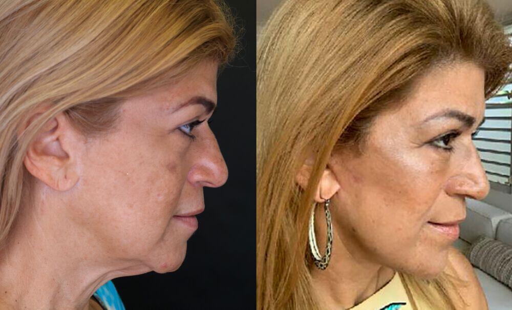 Facelift before and after - before