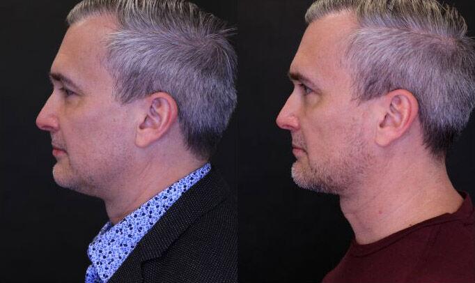 Liposuction before and after - before