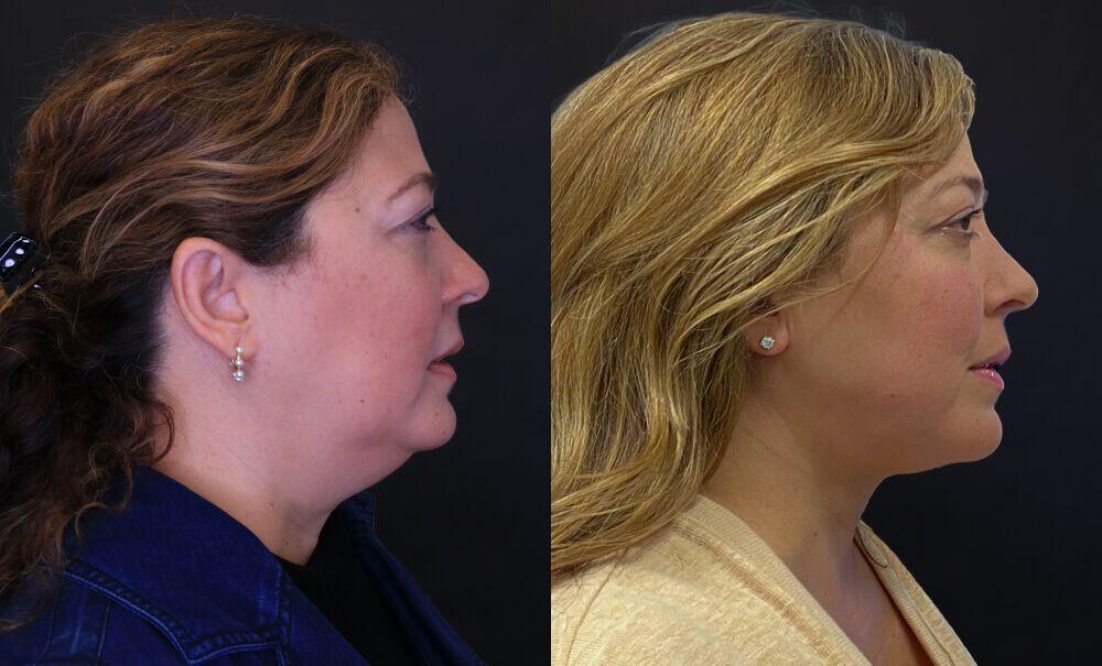 Facelift before and after - before