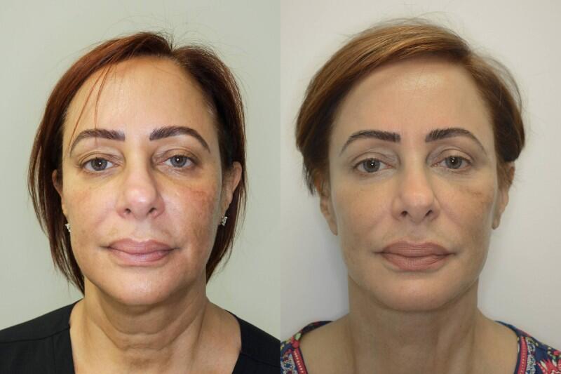 Facelift before and after - before