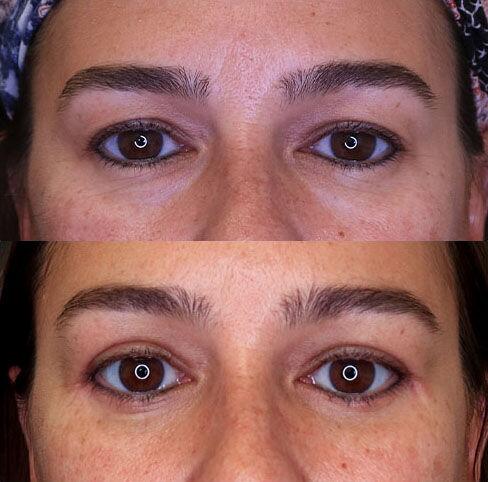 Blepharoplasty before and after - before