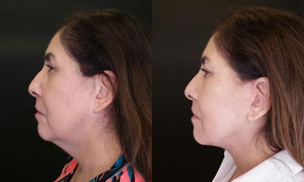 Neck Lift before and after - before