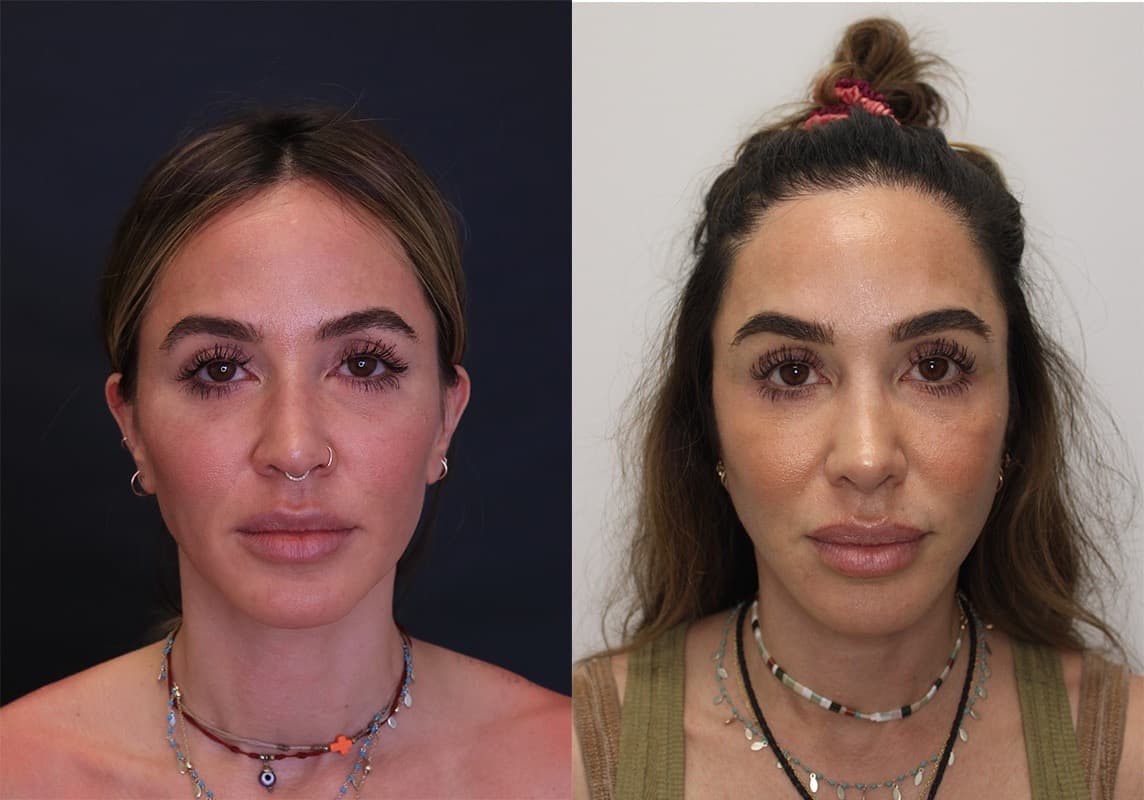 Facelift before and after - before