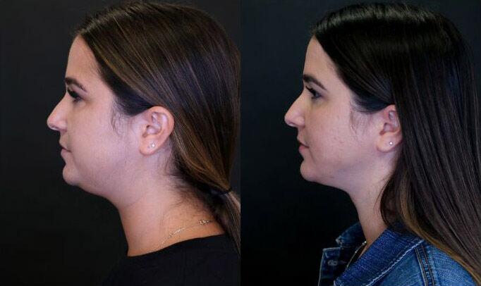Liposuction before and after - before