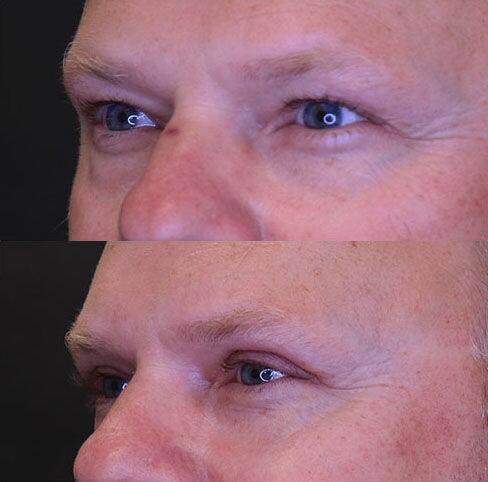 Blepharoplasty before and after - before