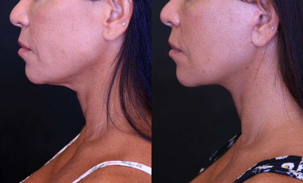 Facelift before and after - before
