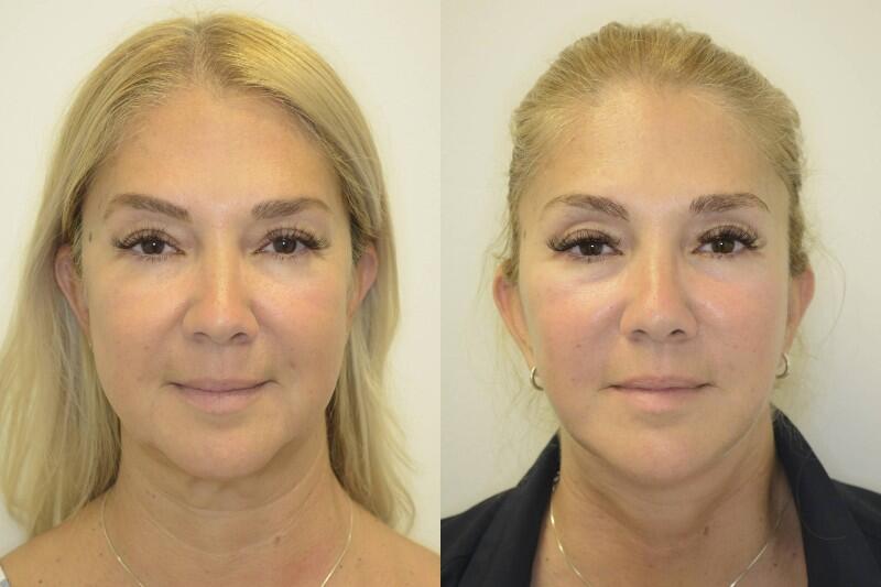 Facelift before and after - before