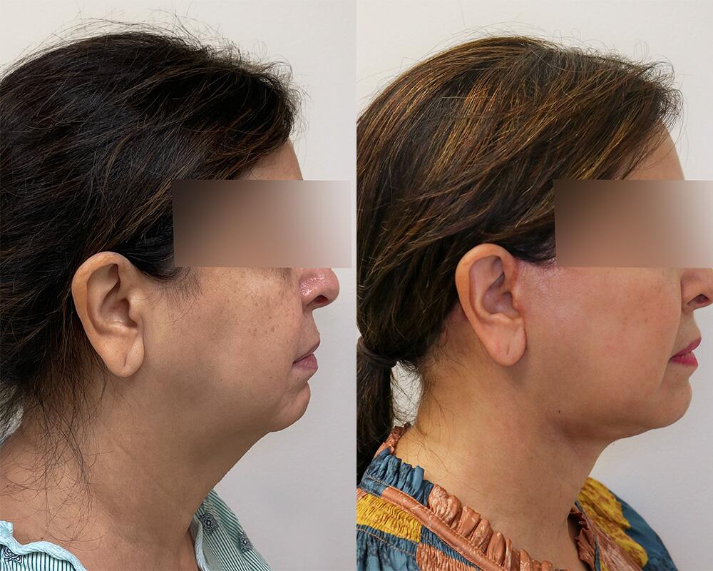 Facelift before and after - before