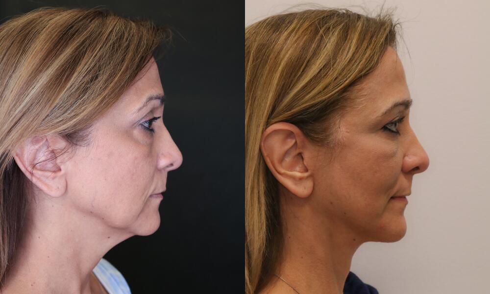 Facelift before and after - before