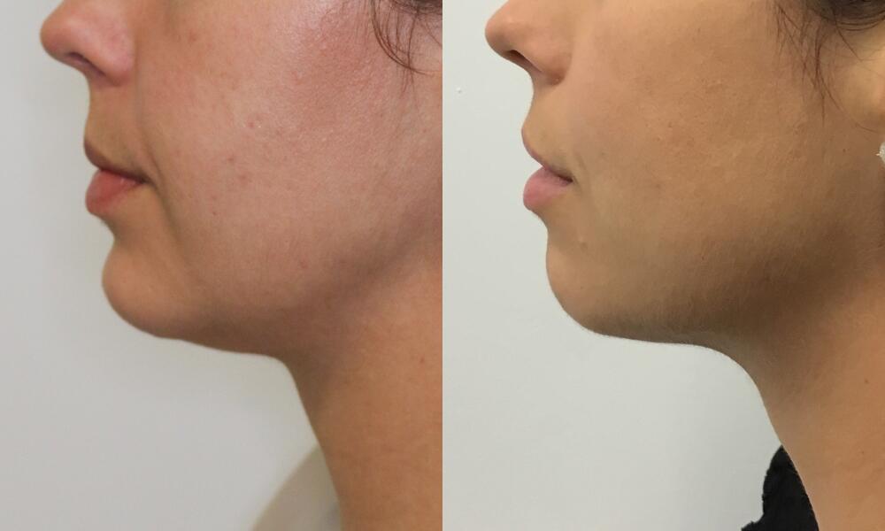 Chin before and after - before