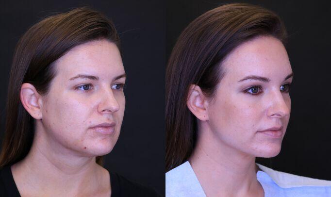 Liposuction before and after - before