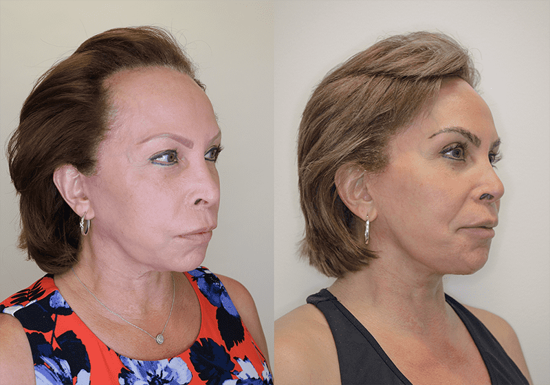 Facelift before and after - before