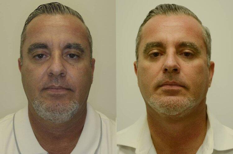 Facelift before and after - before