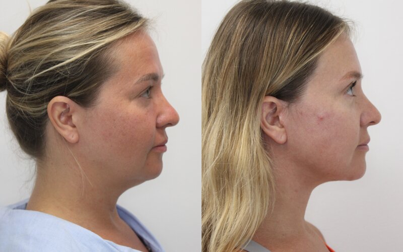 Facelift before and after - before