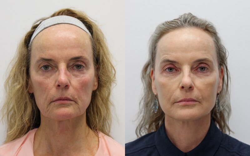 Facelift before and after - before