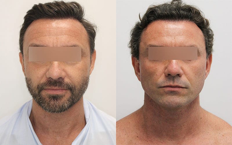 Facelift before and after - before