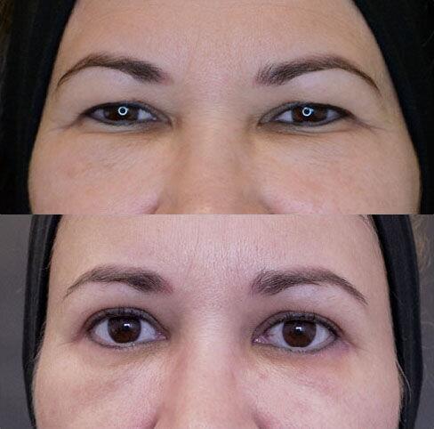 Blepharoplasty before and after - before