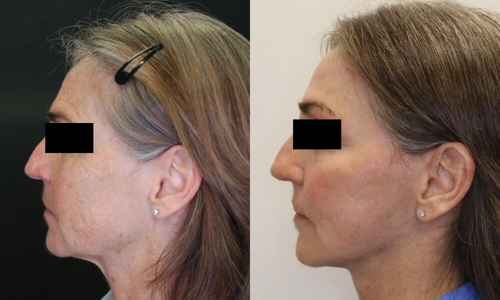 Neck Lift before and after - before
