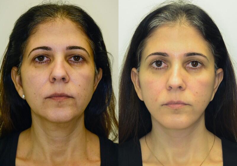 Facelift before and after - before