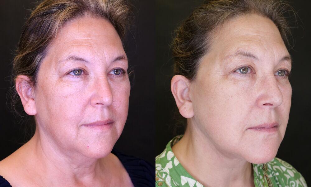 Facelift before and after - before