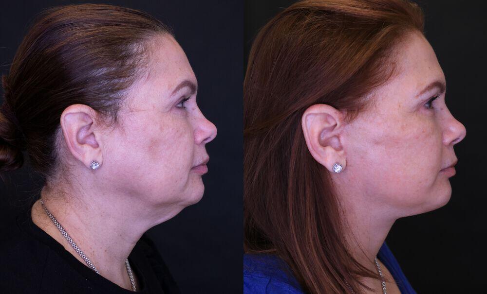 Neck Lift before and after - before