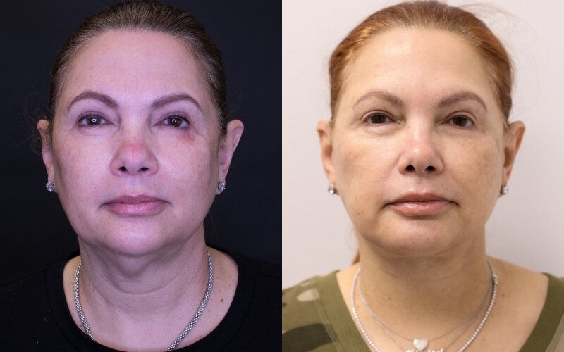 Facelift before and after - before
