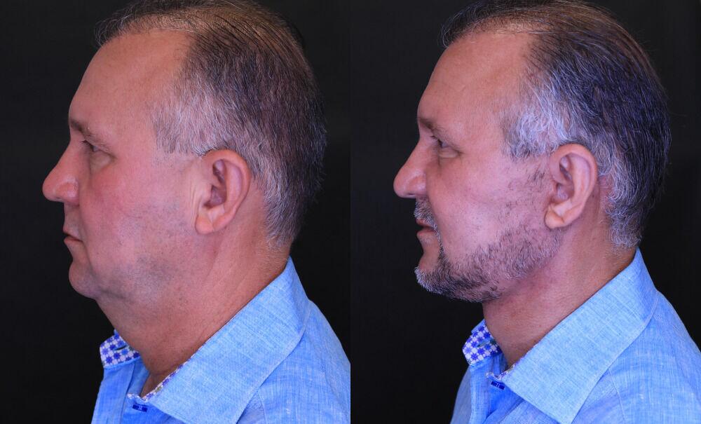 Facelift before and after - before