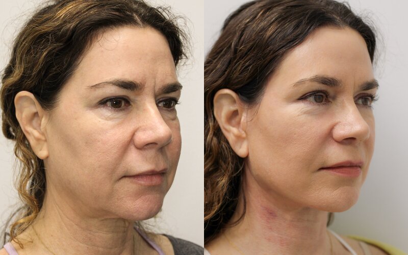 Facelift before and after - before