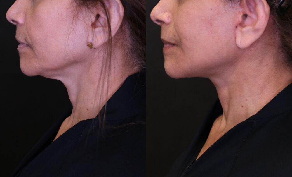 Neck Lift before and after - before