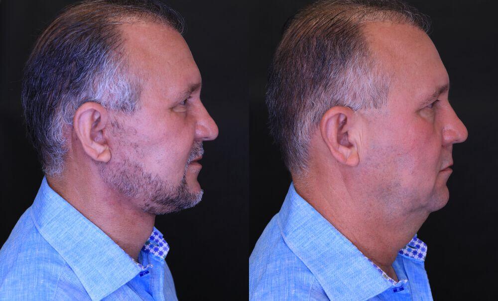 Neck Lift before and after - before