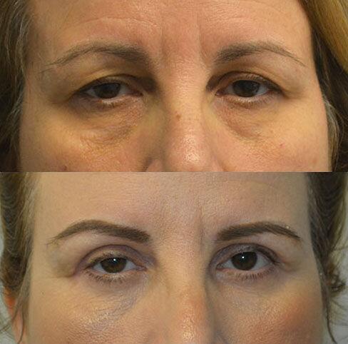 Blepharoplasty before and after - before