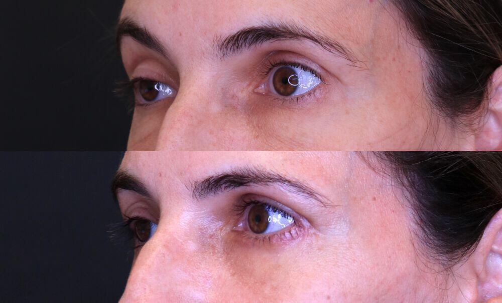 Procedure before and after - before