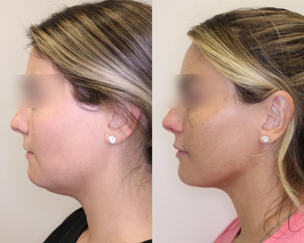 Liposuction before and after - before