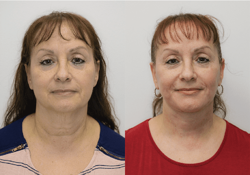 Facelift before and after - before