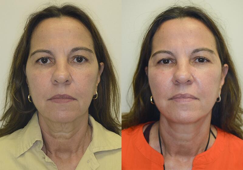 Facelift before and after - before