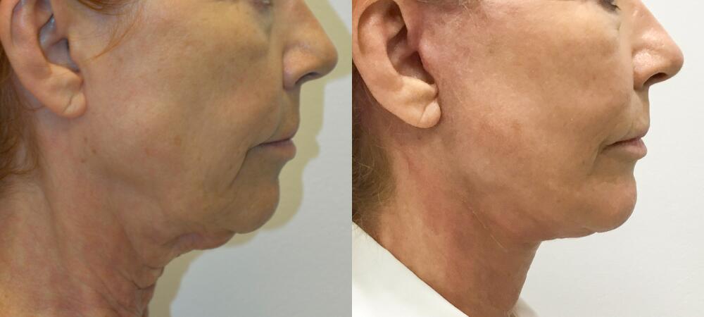 Neck Lift before and after - before