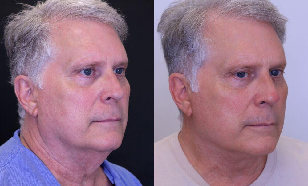 Facelift before and after - before