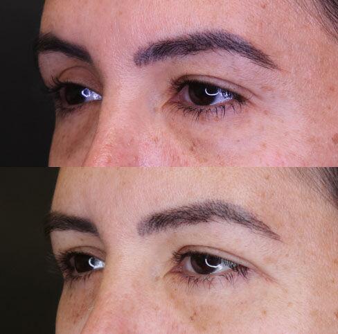 Blepharoplasty before and after - before