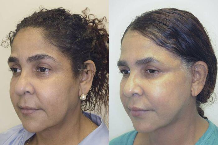 Facelift before and after - before