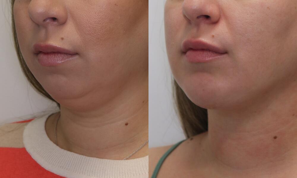 Chin before and after - before