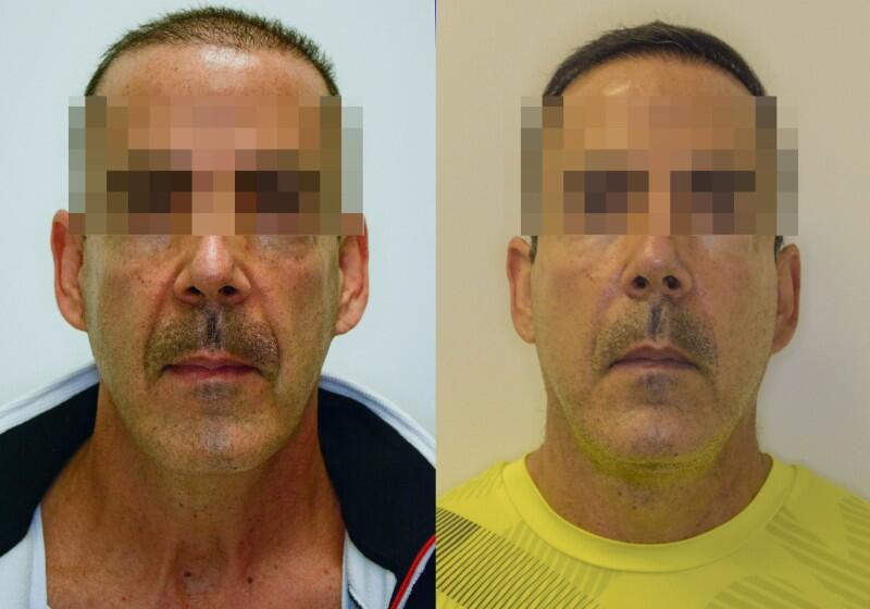Facelift before and after - before
