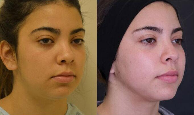 Liposuction before and after - before