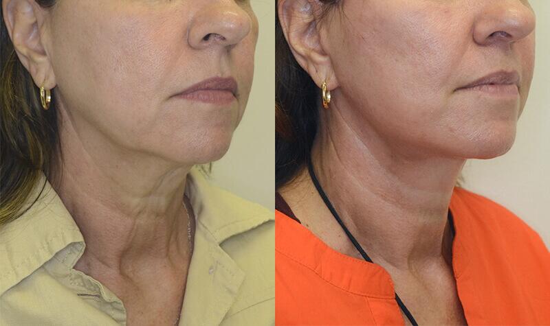 Neck Lift before and after - before