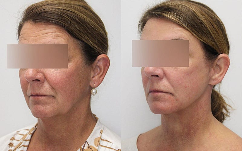 Facelift before and after - before