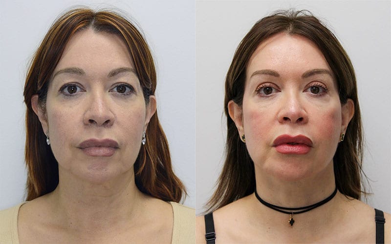 Facelift before and after - before