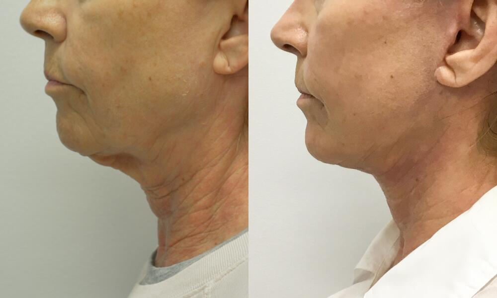 Chin before and after - before