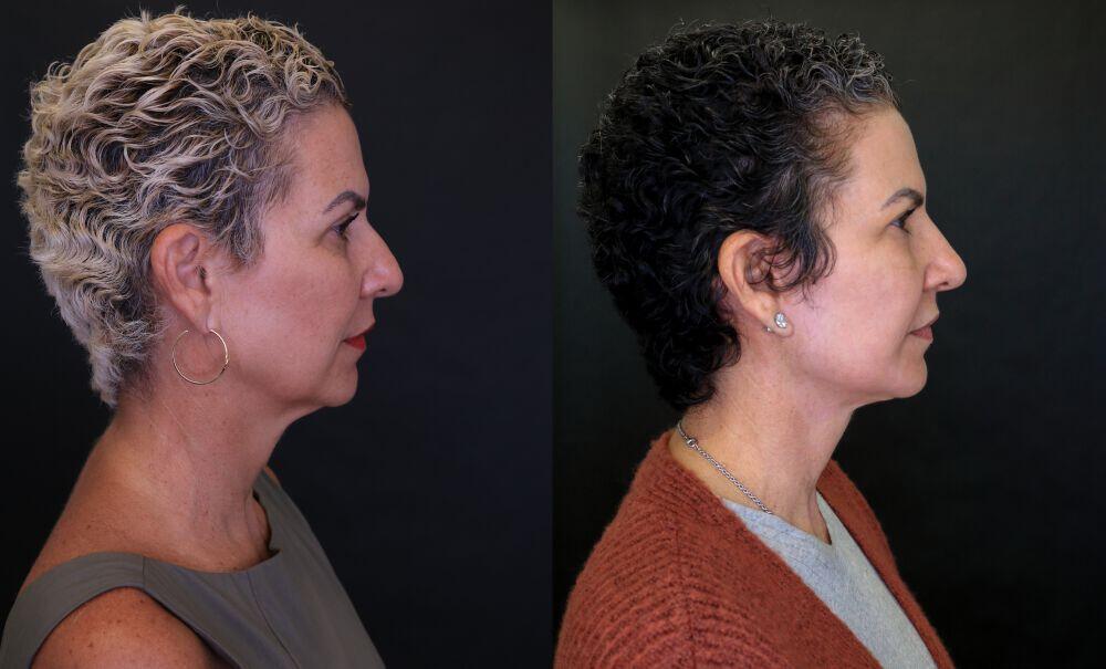 Facelift before and after - before